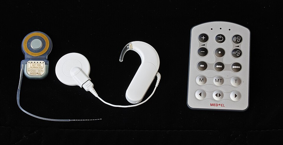 人工内耳(コクレアインプラント)の外部コイルと体内インプラント